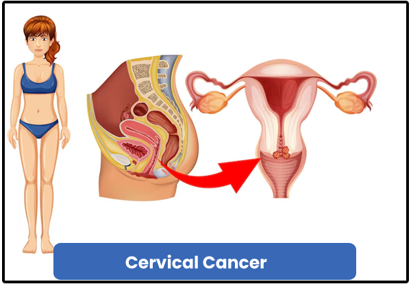 Cervical Cancer