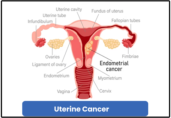 Uterine Cancer