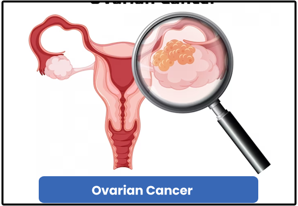 Ovarian Cancer