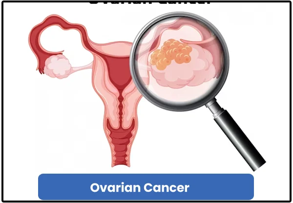 Ovarian Cancer