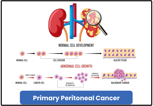 Primary Peritoneal Cancer