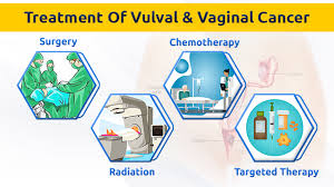 Vaginal Cancer Surgeon